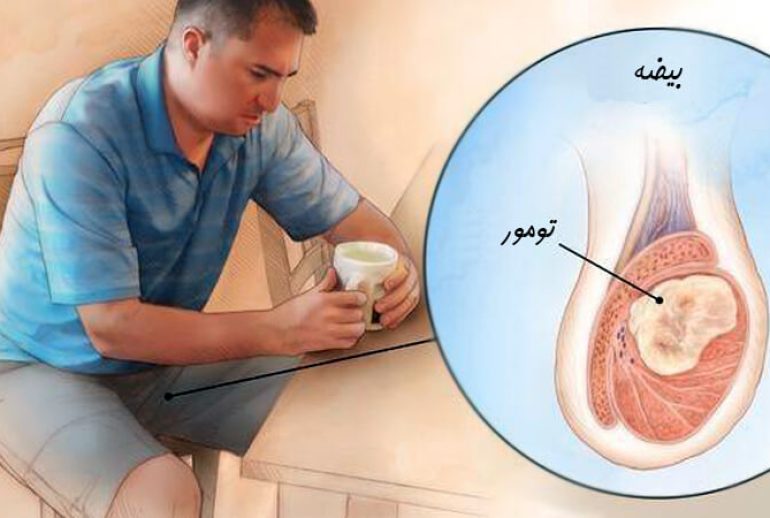 دکتر سرطان بیضه - کرج