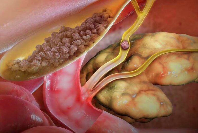 دکتر سنگ مثانه - رشت