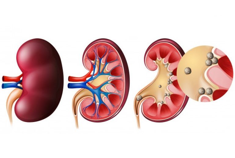 دکتر سنگ کلیه - تهران