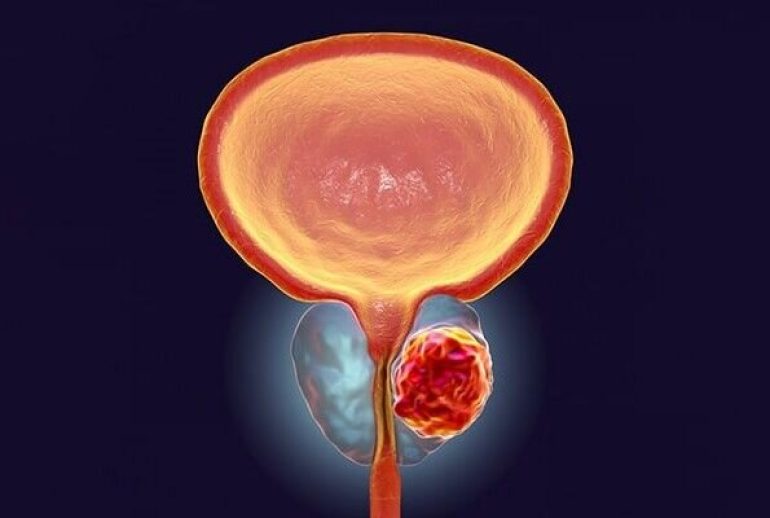 دکتر پروستاتیت یا التهاب پروستات - اصفهان